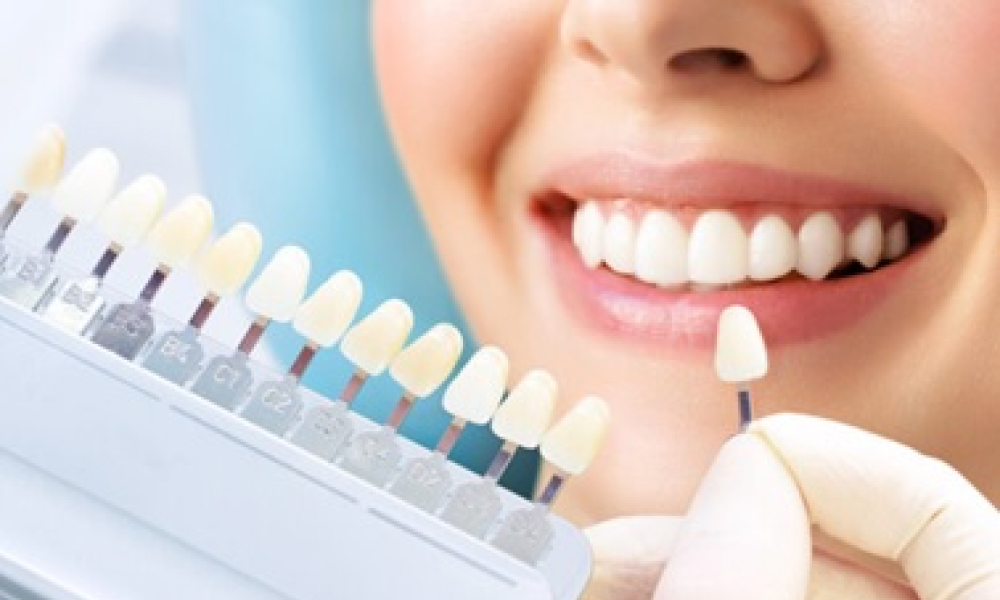 ホワイトニングのメリットと注意点