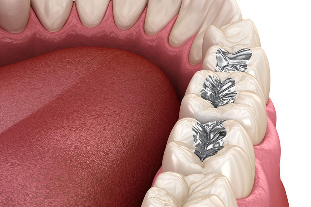 金銀パラジウム合金