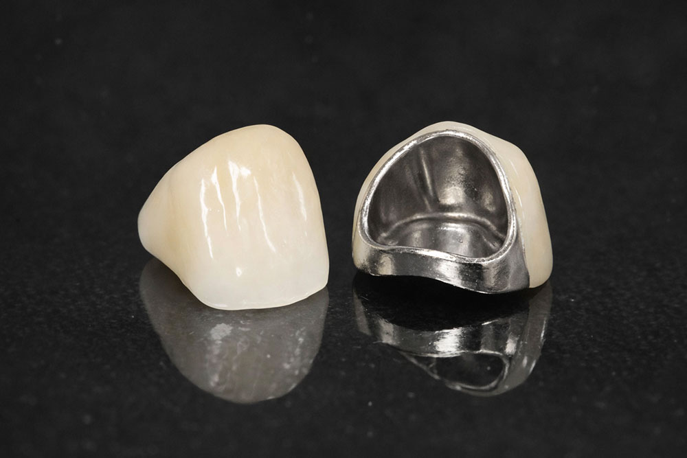 硬質レジン前装冠