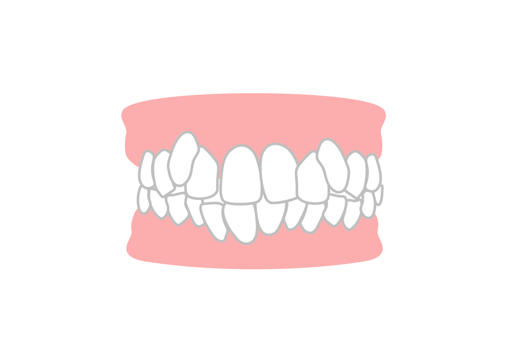 叢生（そうせい）