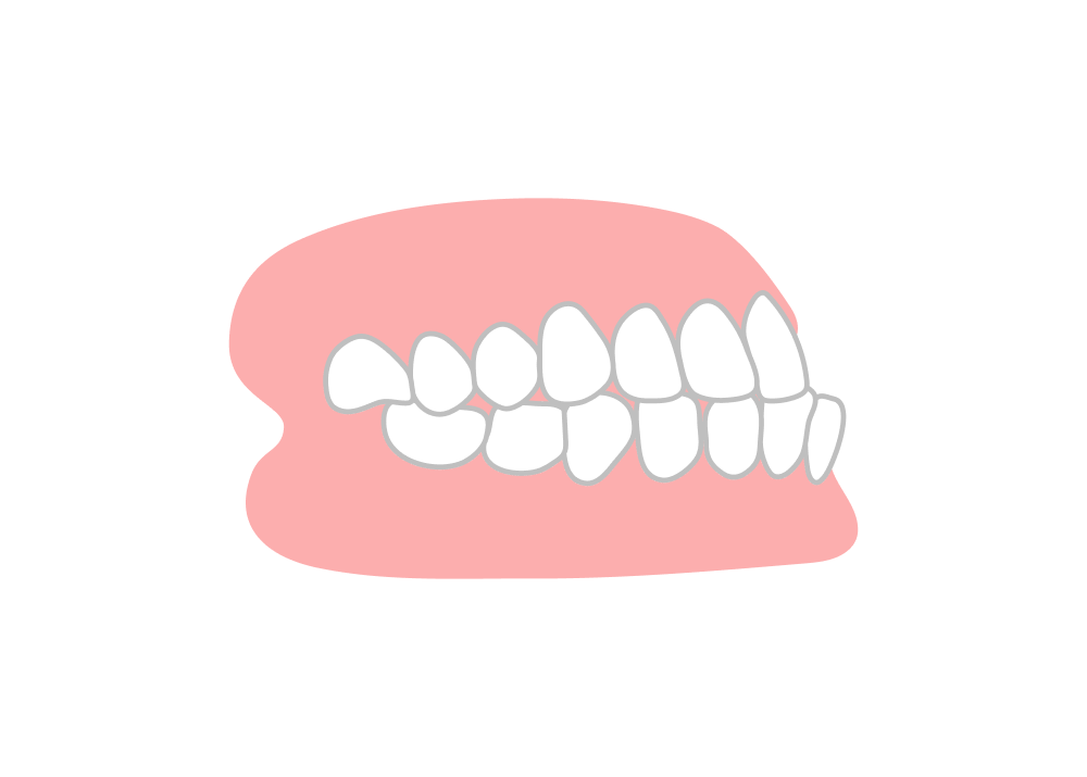 反対咬合（はんたいこうごう）