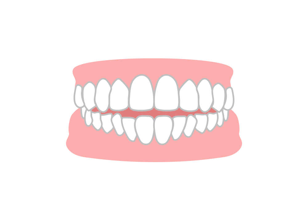 空隙歯列（くうげきしれつ）