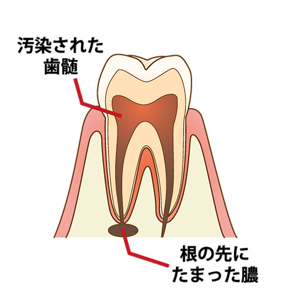 深い虫歯によって、歯髄が細菌に感染した歯