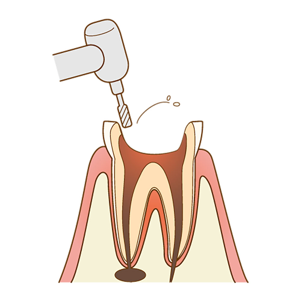 虫歯部分を丁寧に完全に除去