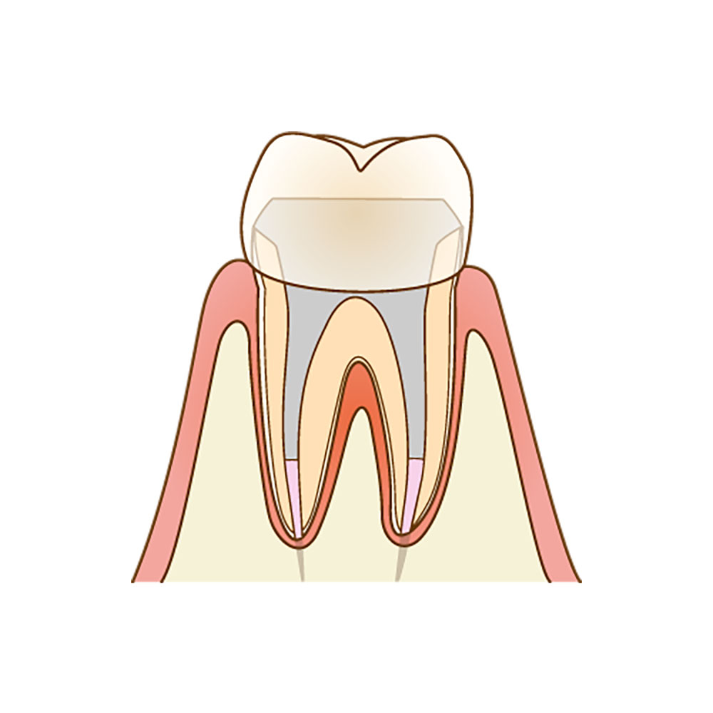 セラミック製または金属製のクラウンで歯をかぶせて修復